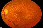 Livelayer a semi-automatic software program for segmentation of layers and diabetic macular edema in optical coherence tomography images
